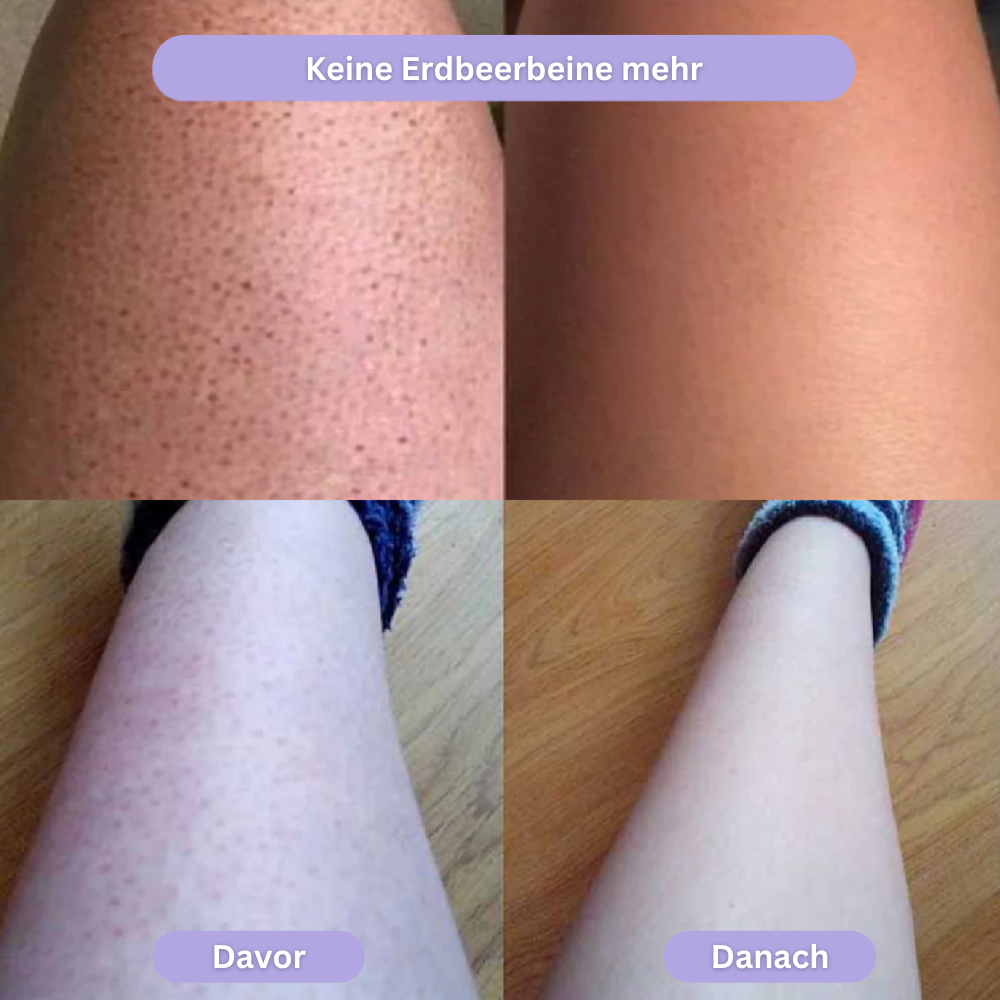 Gleam - Haarentfernung